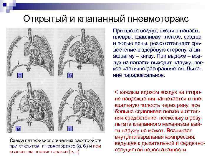 Симптомы пневмоторакса - яшкинская районная больница