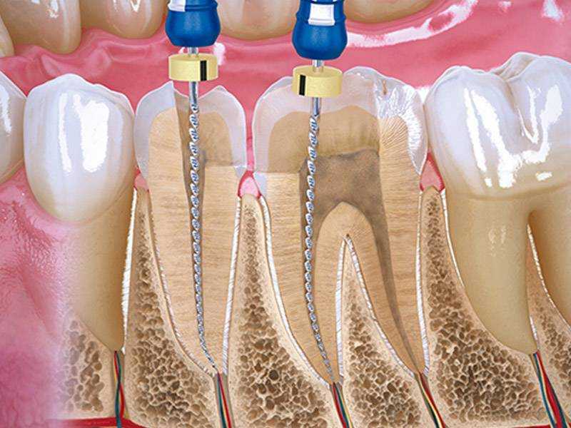 Депульпирование зуба: что это такое, показания и последствия