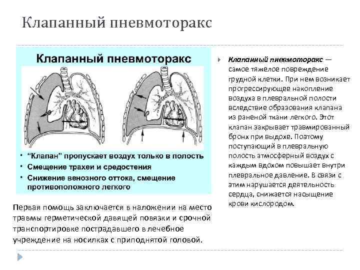 Спонтанный пневмоторакс карта вызова смп