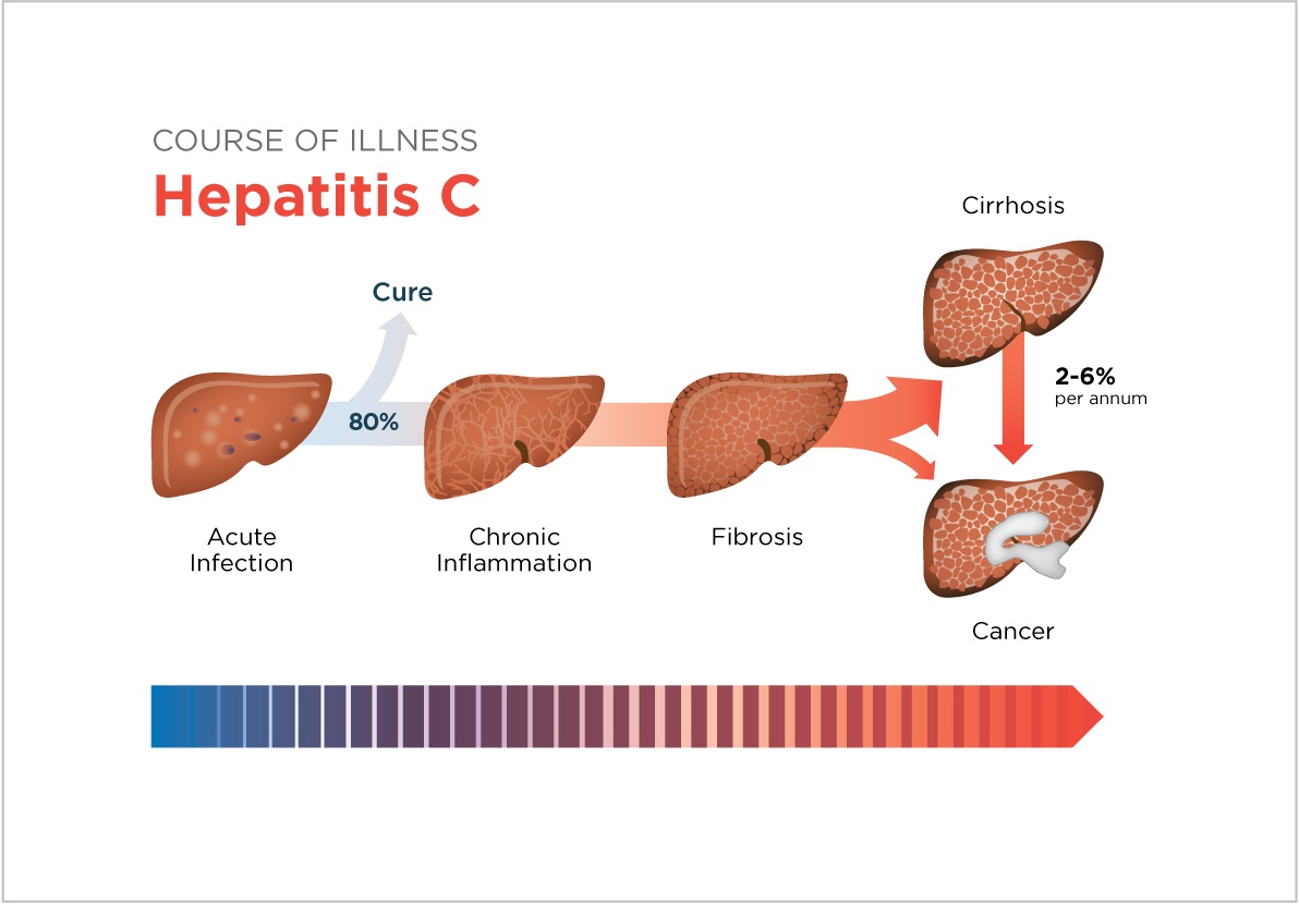 Можно ли при лечение гепатита с. Гепатит c. Цирроз печени гепатит ц.