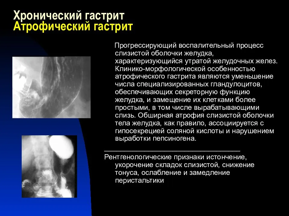 Расстройство пищеварения желудочно-кишечного тракта: диспепсия