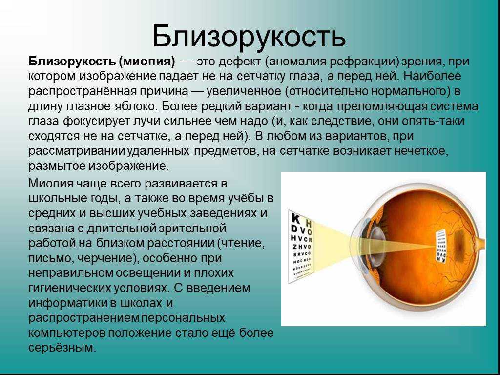 Информация через зрение. Близорукость. Близорукость миопия. Заболевание глаз миопия. Заболевание органов зрения миопия.
