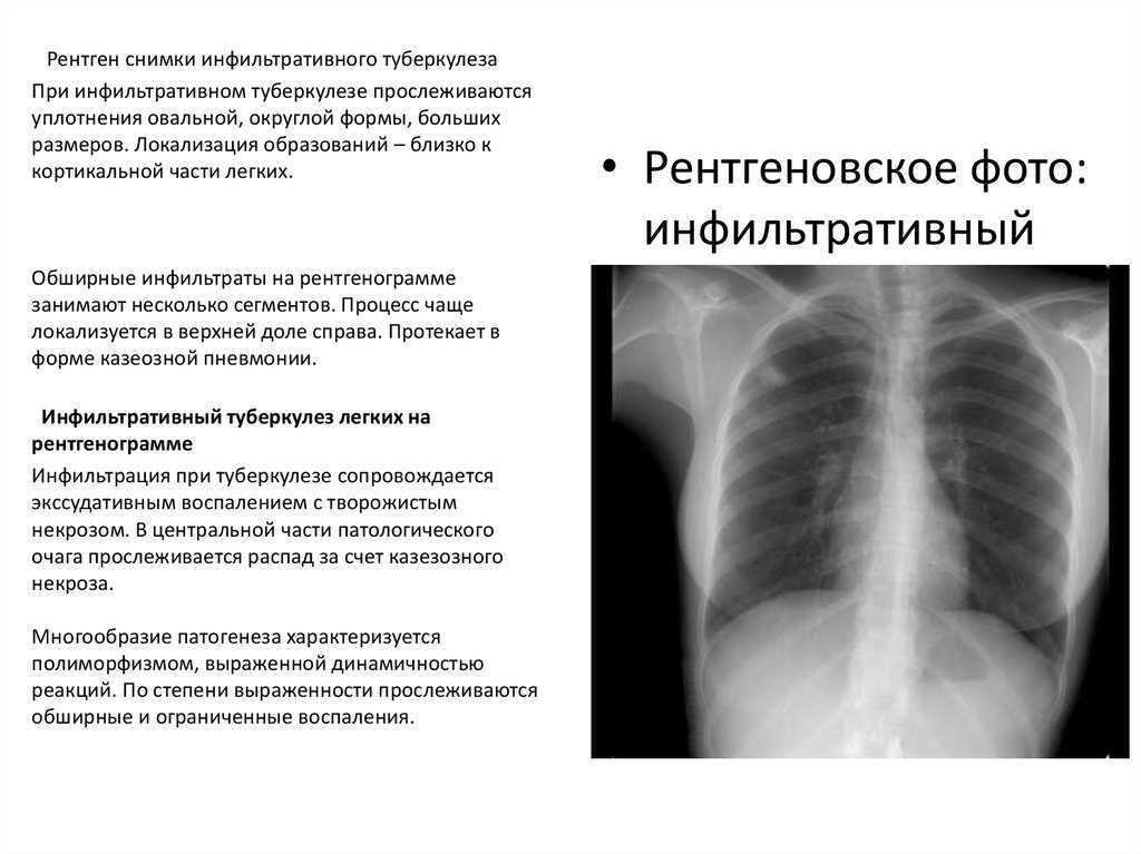 Современные методы обследования в дифференциальной диагностике туберкулеза | медичний часопис