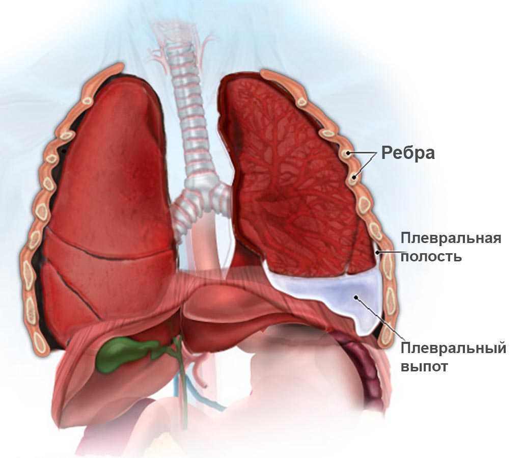 Метастазы в лёгких