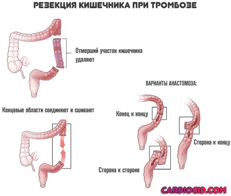 Стерилизация женщины — последствия, способы проведения, показания и противопоказания
