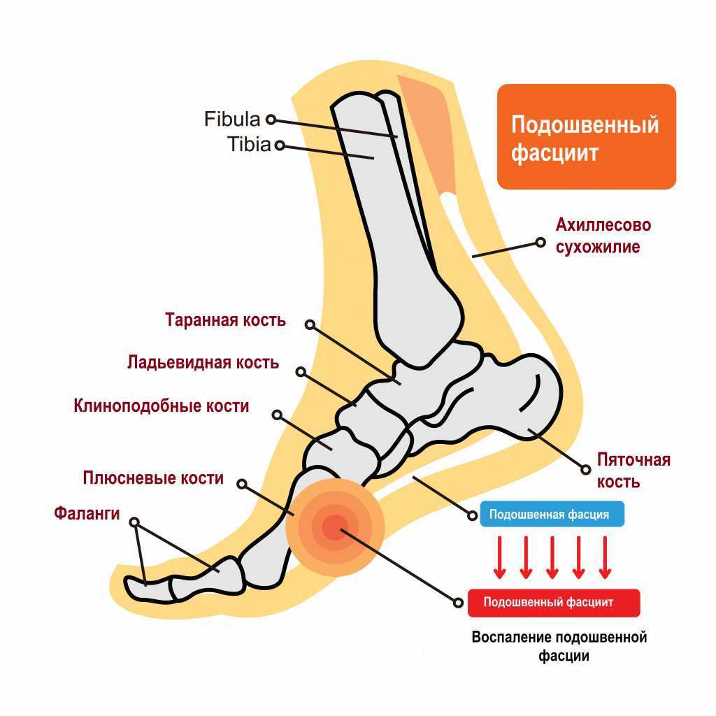 Фасциит пятки симптомы лечение препараты. Плантарный апоневроз стопы.