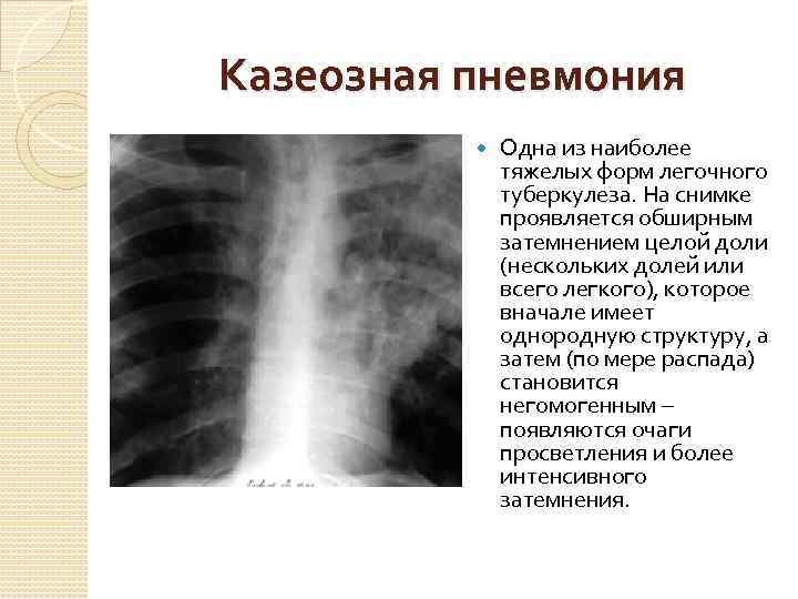 Диагностика туберкулеза легких методом малодозовой цифровой рентгенографии (продолжение)