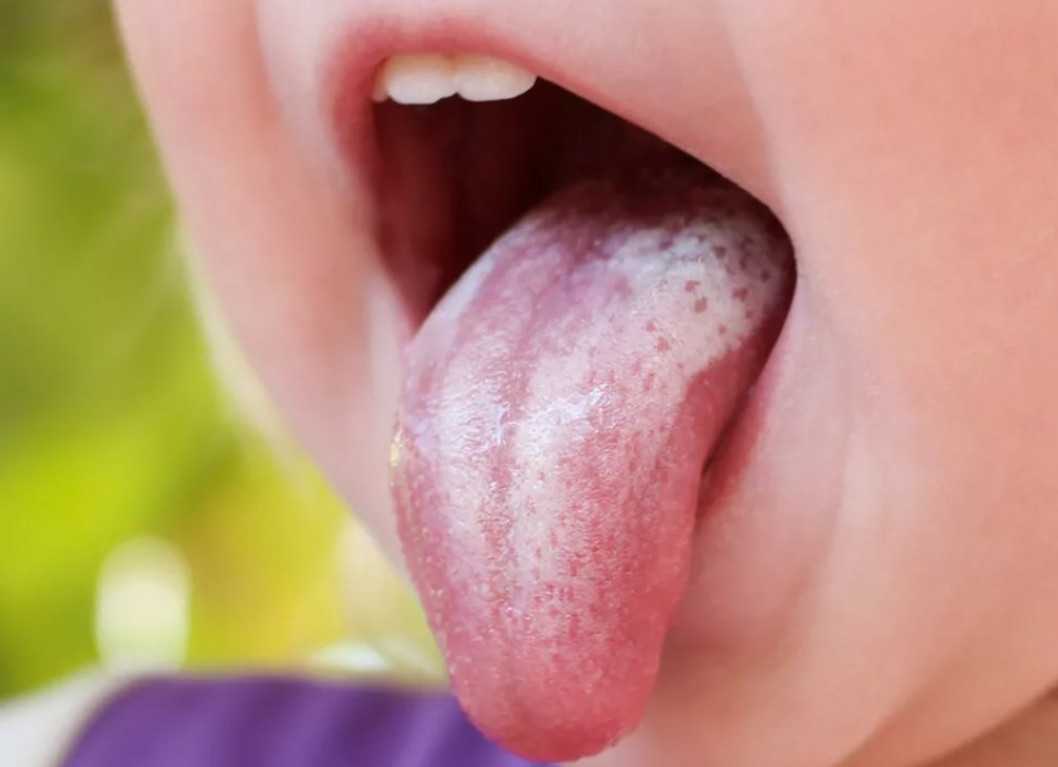 Синдром жжения во рту