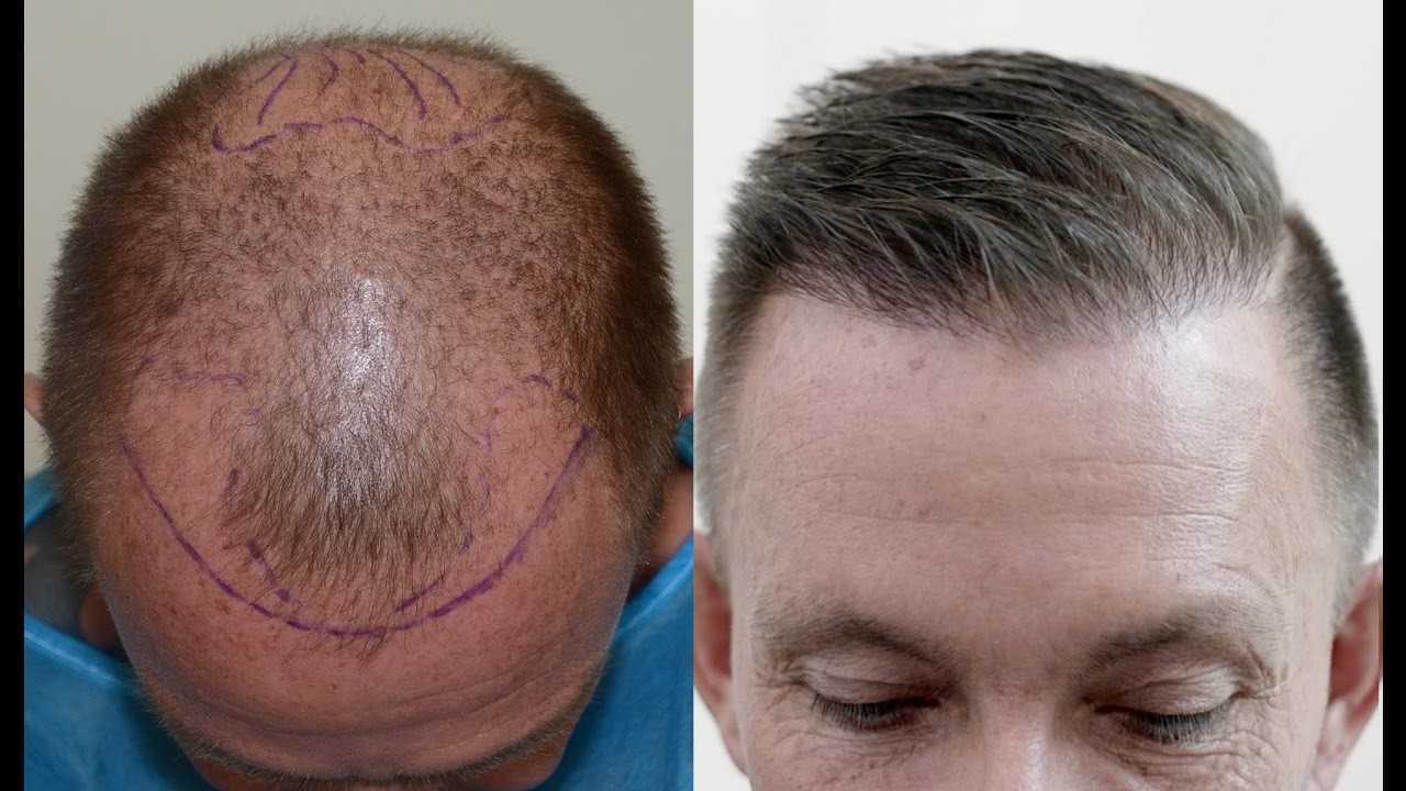 Голова после пересадки волос