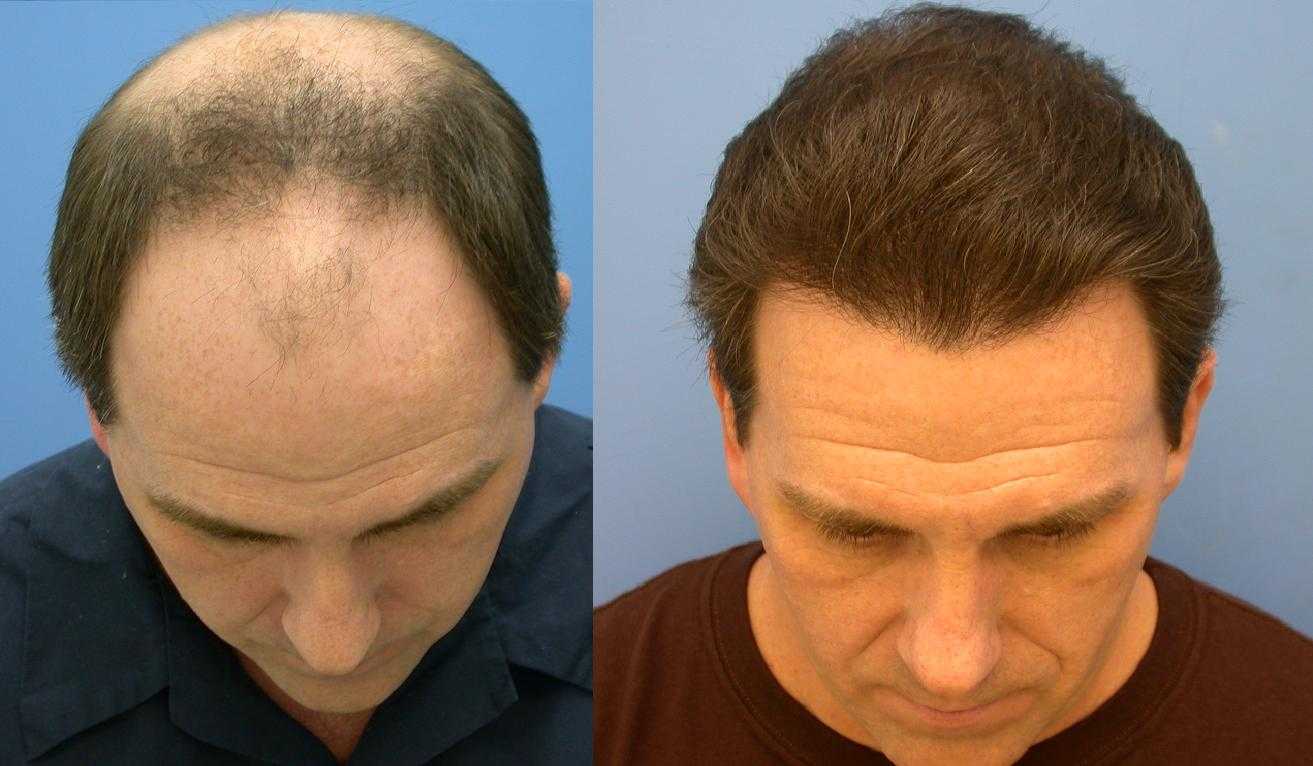 волосы на груди у мужчин выпадают волосы фото 111