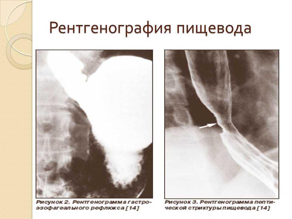 Стриктура пищевода рентген. Рентген пищевода при ГЭРБ. Рефлюкс эзофагит пищевода рентген.