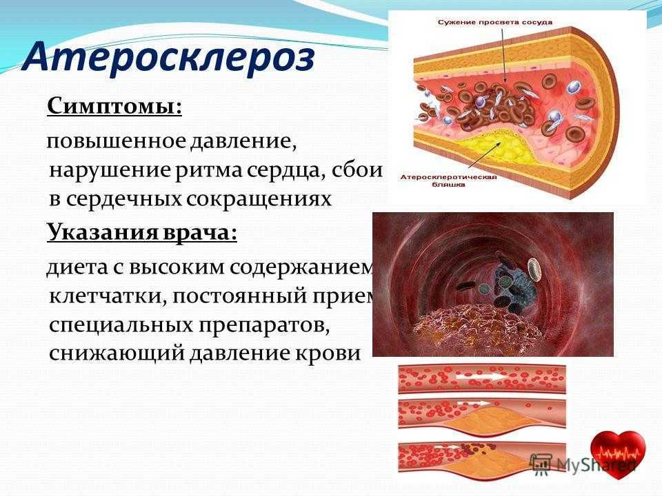 Признаки атеросклеротического поражения артерии