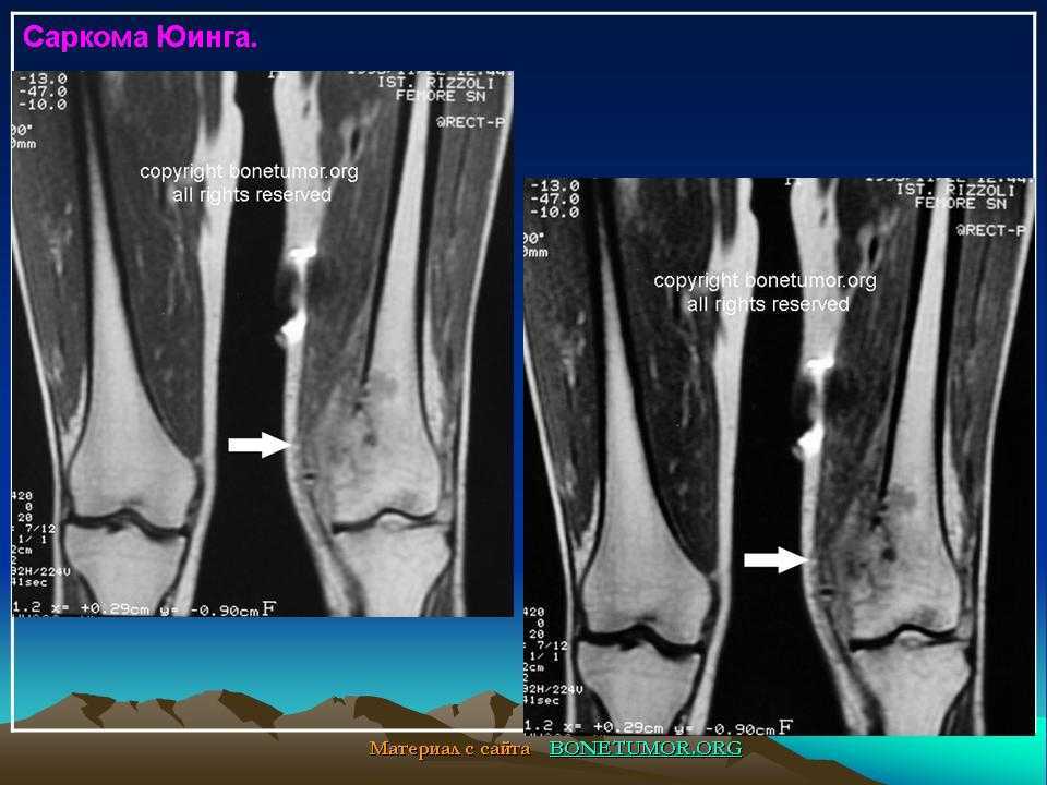 Остеосаркома симптомы фото