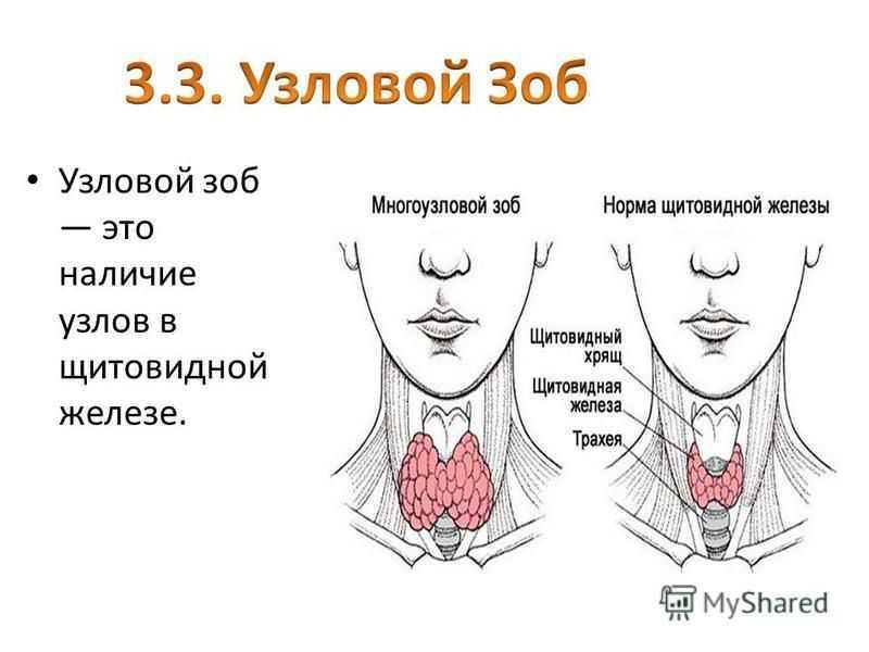 10 признаков проблем с щитовидной железой и 7 шагов к здоровью щитовидки