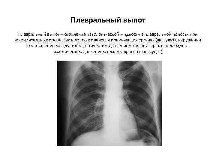 Плевральный выпот. Малый плевральный выпот слева что это. Плевральный выпот симптомы. Малый правосторонний плевральный выпот. Двухсторонний малый плевральный выпот что это такое.