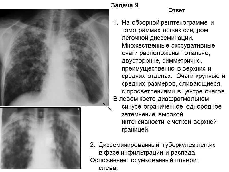 Как выглядит туберкулез на снимке рентгена: милиарный, очаговый, инфильтративный