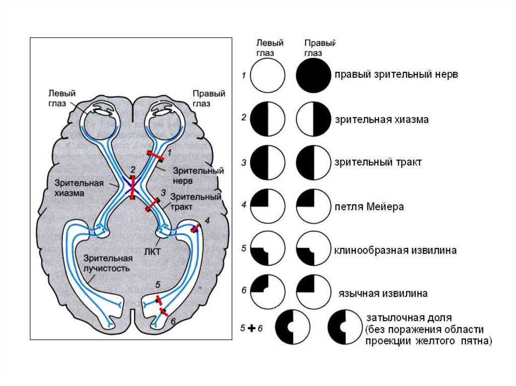 Зрительный нерв неврология схема. Верхнеквадрантная гемианопсия очаг поражения. Квадрантная гемианопсия. Поражение зрительного нерва гемианопсия. Монимен