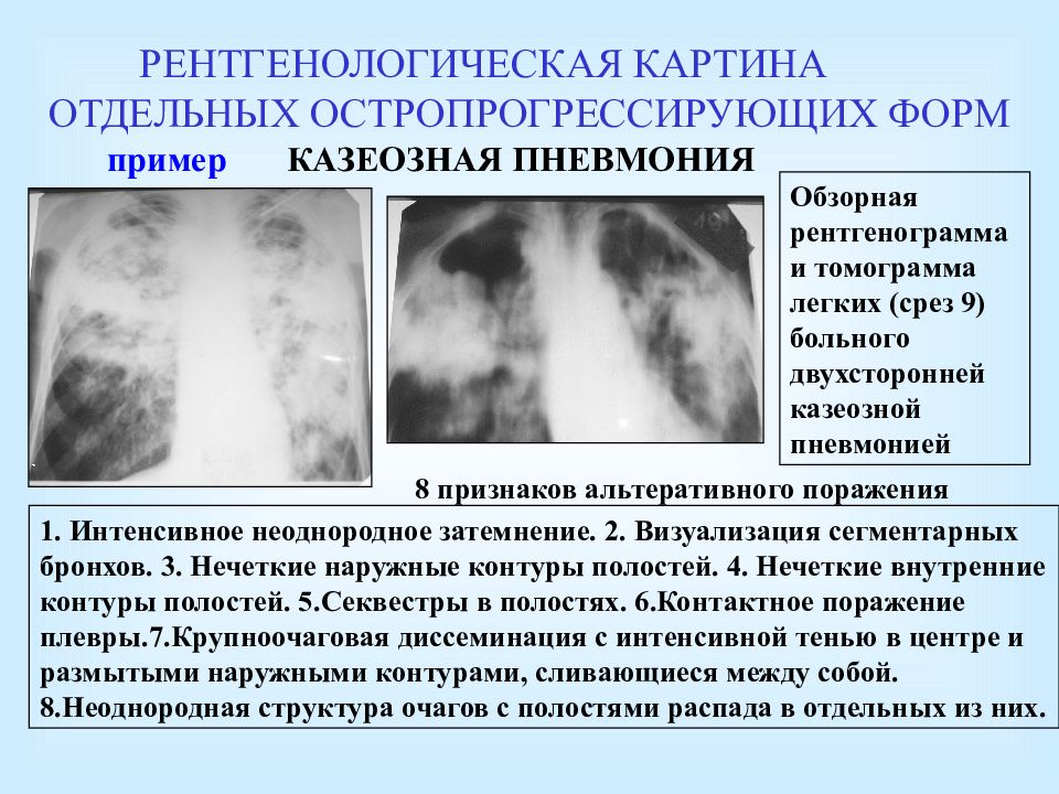 Туберкулез на рентгене: описание, показания к проведению, расшифровка результатов