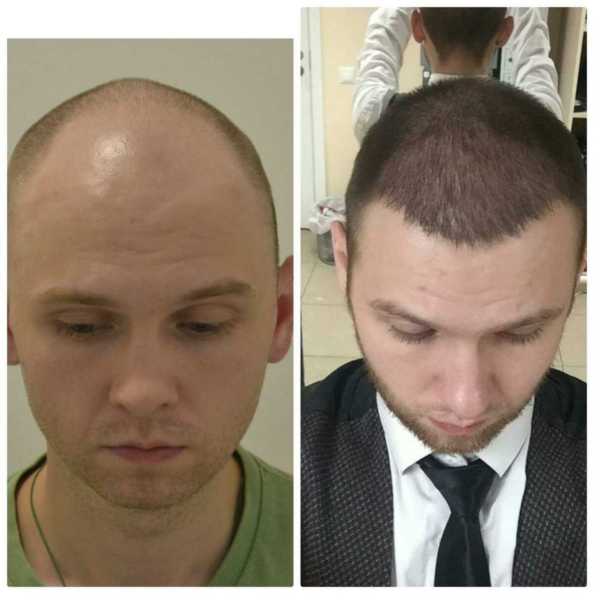 реальные фото после пересадки волос