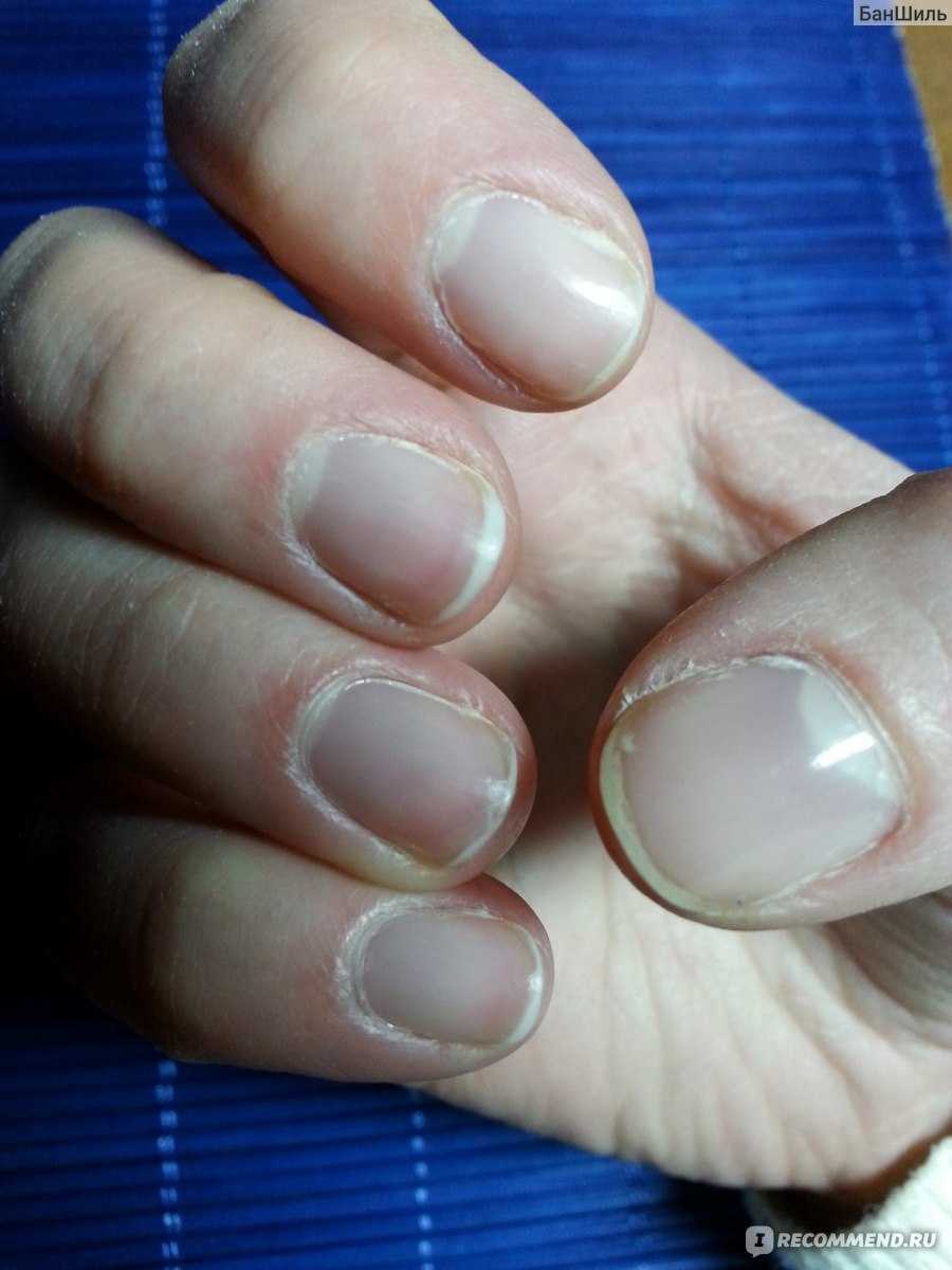 Почему ногти стали тоньше. Тонкие ногти. Очень тонкие слоящиеся ногти.