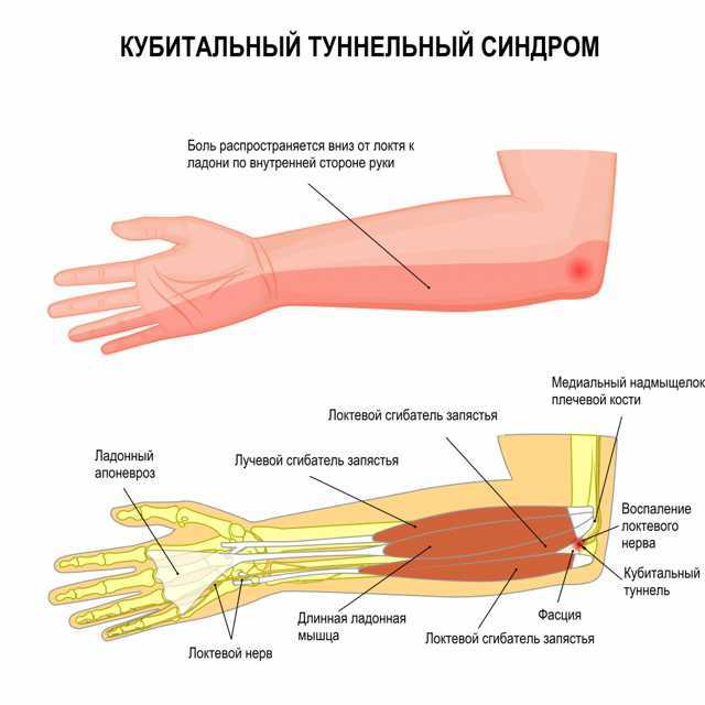 Почему болят пальцы на правой руке. Кубитальный синдром локтевого нерва симптомы. Туннельный синдром лучезапястного сустава. Туннельный синдром локтевого нерва. Кубитальный туннельный синдром локтевого нерва.