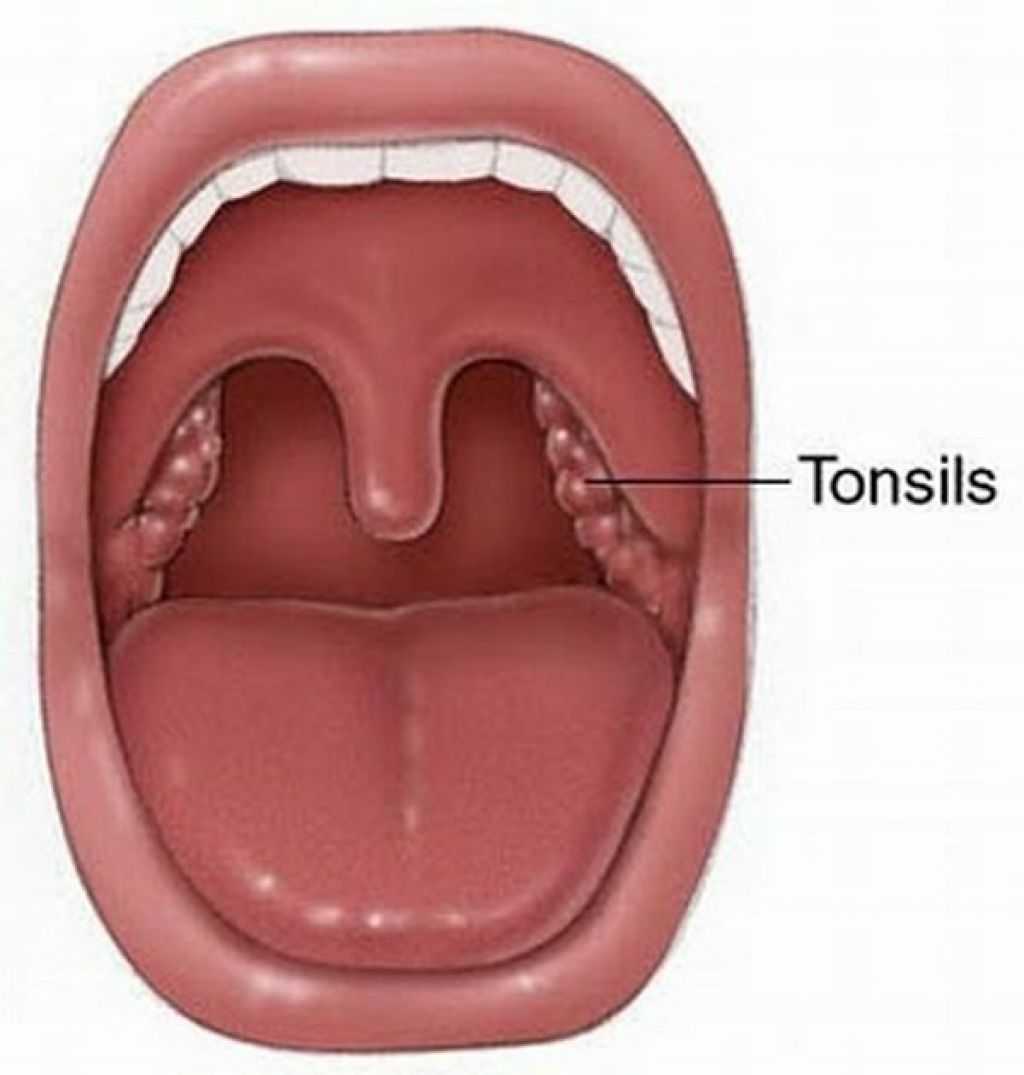 Трубная миндалина тонзиллит