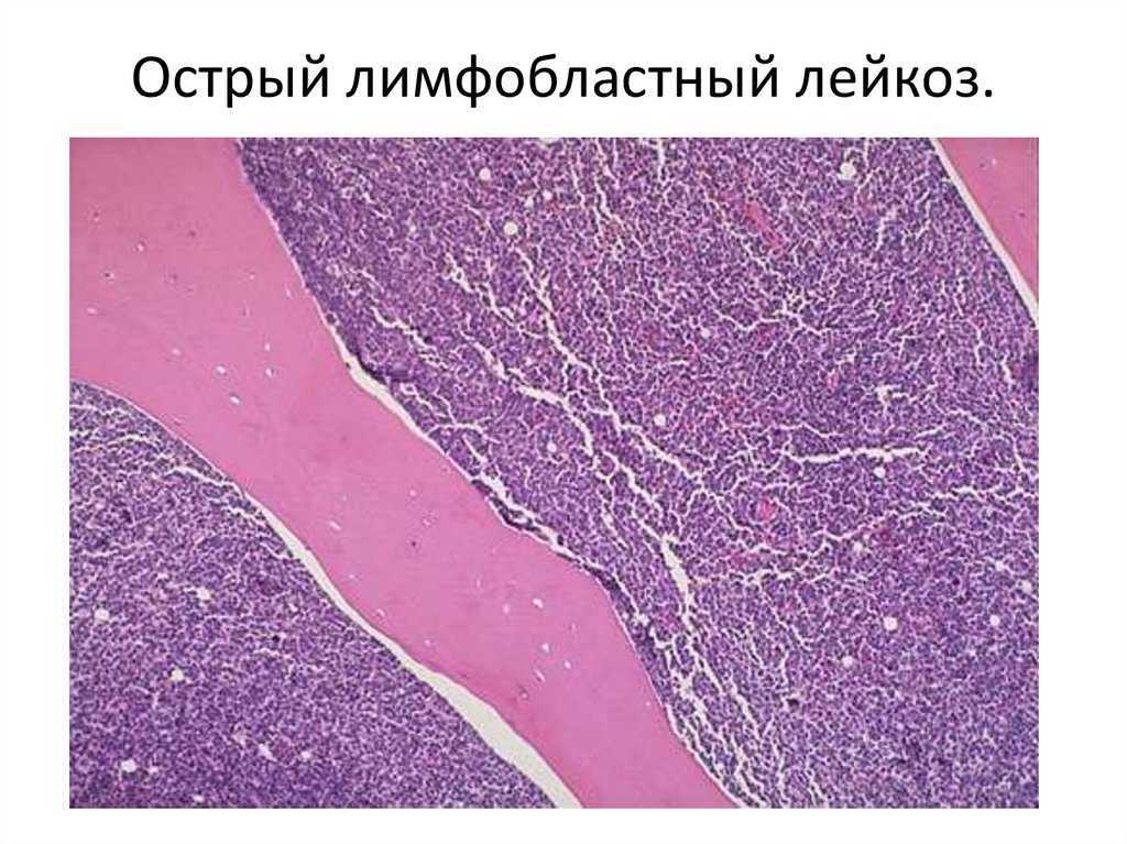 Острый лимфобластный лейкоз - симптомы болезни, профилактика и лечение острого лимфобластного лейкоза, причины заболевания и его диагностика на eurolab
