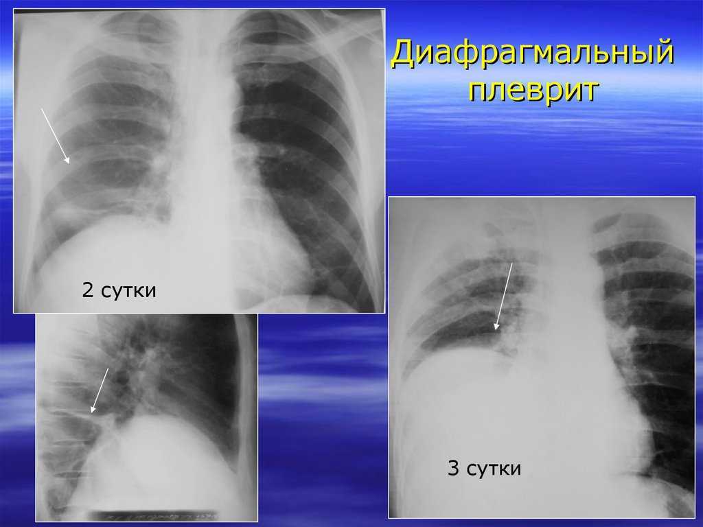 Сухой плеврит рентгенологическая картина