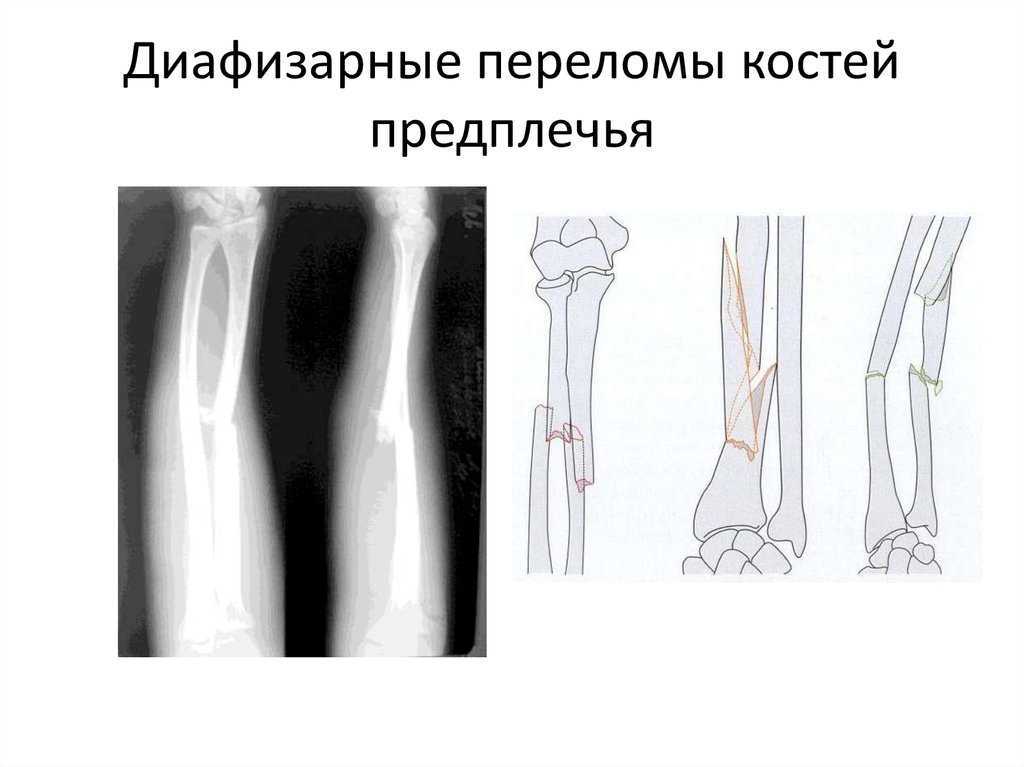 Закрытый перелом предплечья карта вызова смп