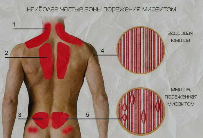 Взаимосвязь между болью в спине и заболеваниями жкт