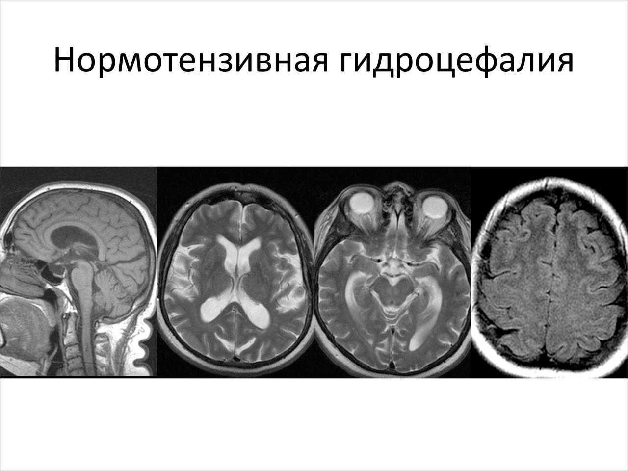 Клинические симптомы гидроцефалии. Нормотензивная гидроцефалия мрт. Наружная гидроцефалия головного мозга кт. Компьютерная томография головного мозга гидроцефалия.