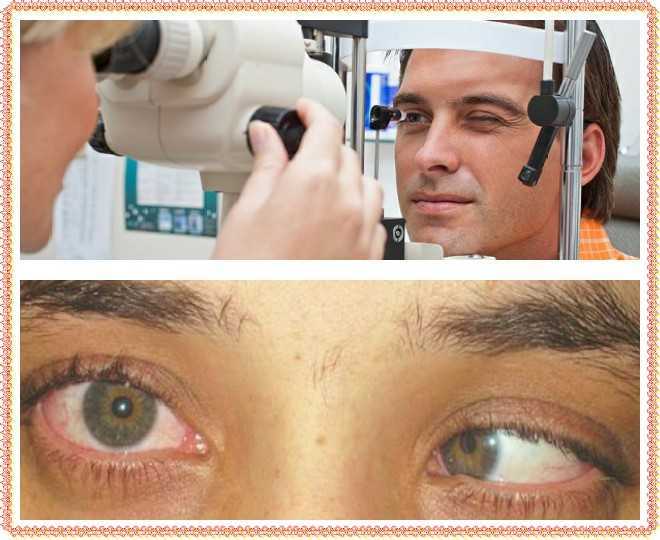 Двоение в глазах (диплопия): причины и лечение
