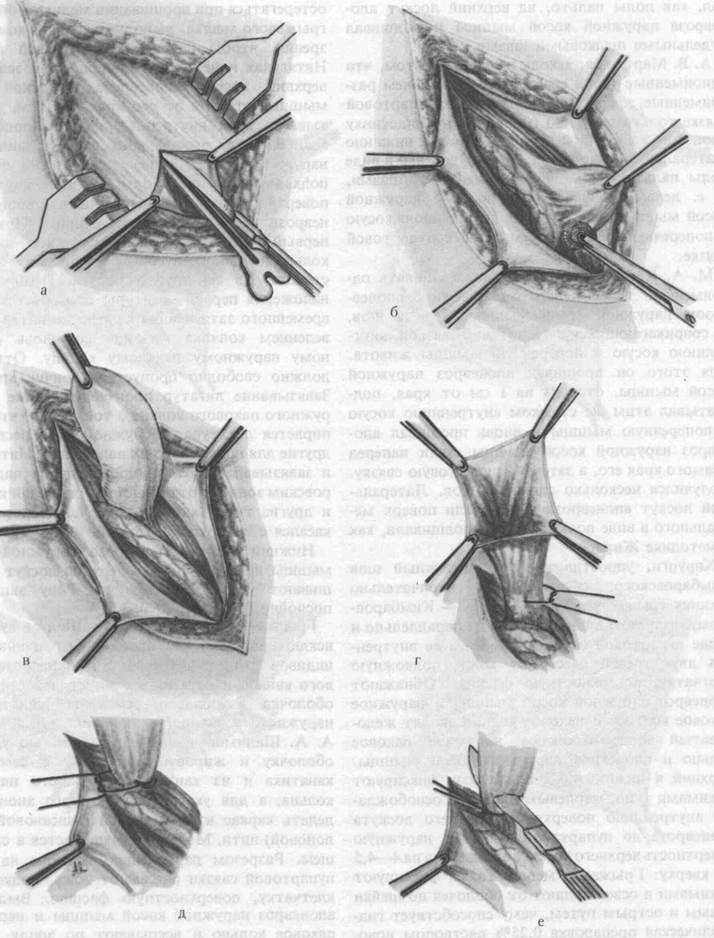 Паховая грыжа отзывы. Грыжесечение при паховой грыже. Грыжесечение по Бассини паховая грыжа. Грыжесечение по Дюамелю 2. Этапы грыжесечения при паховой грыжи.