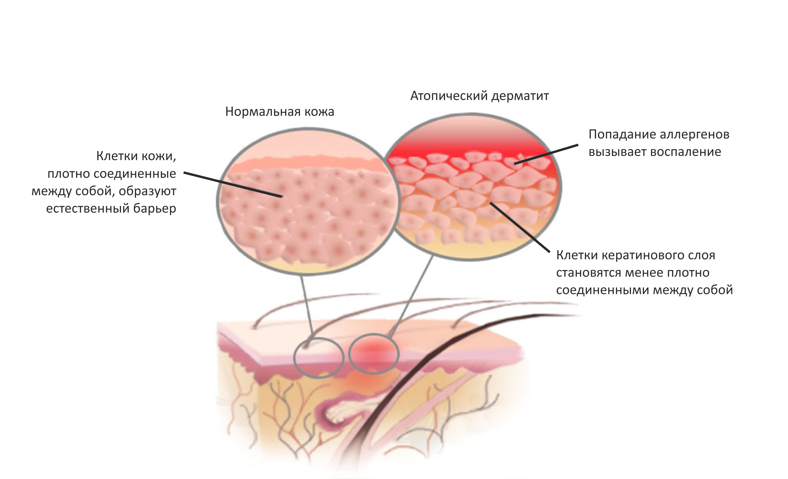 Характерными особенностями атопического дерматита являются сильный зуд и клинический полиморфизм, определяющие разнообразие клинических форм заболевания
