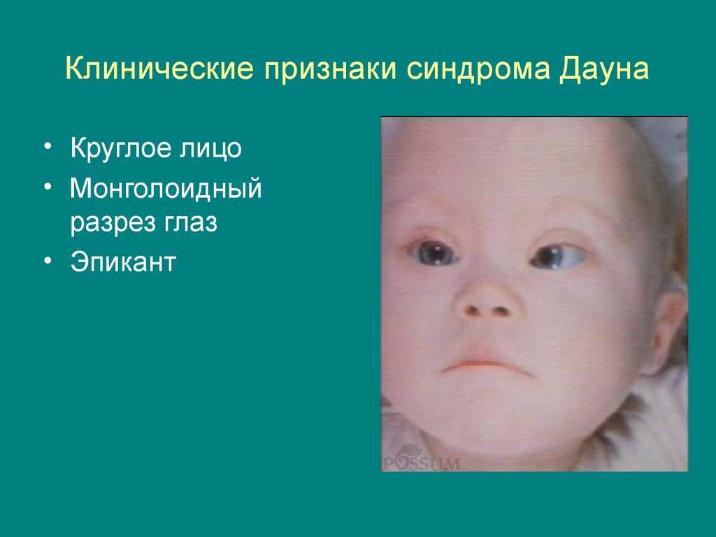 Генетический метод исследования - кариотипирование
