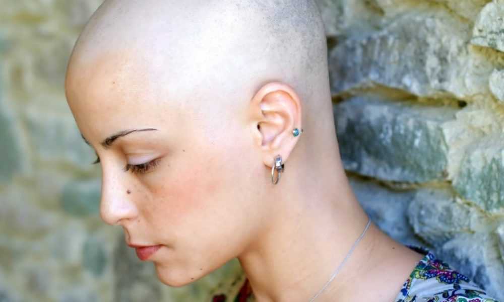 Какие волосы после химиотерапии. Выпадение волос после химиотерапии. Лысые женщины после химиотерапии. После химиотерапии выпадают волосы. Облысение после химиотерапии.