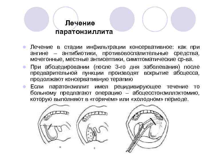 Паратанзиальная абсцесс карта вызова