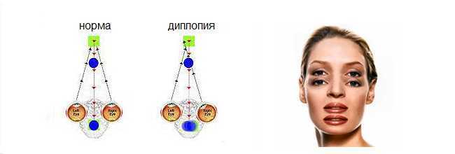 Раздвоение изображения в глазах причина и лечение