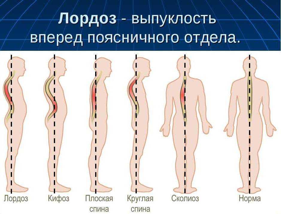 Лордоз поясничного отдела позвоночника: что значит, если он выпрямлен?