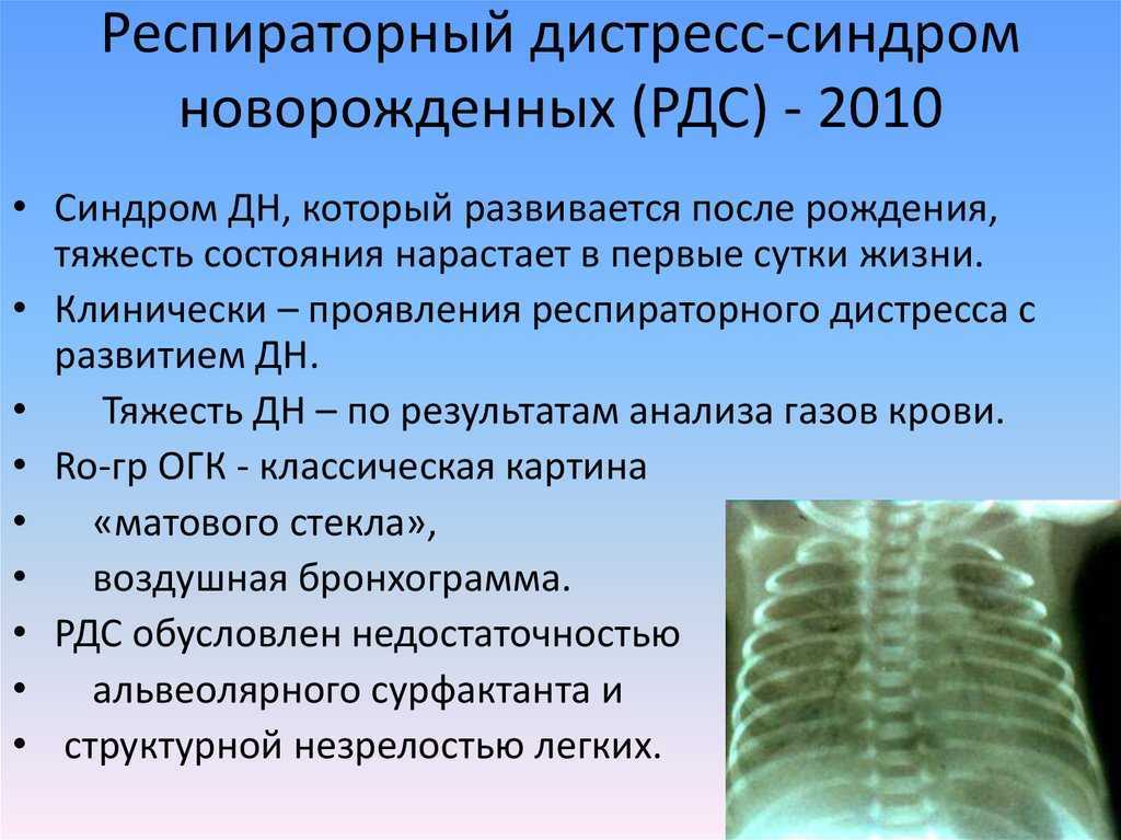 Респираторный дистресс синдром новорожденных презентация