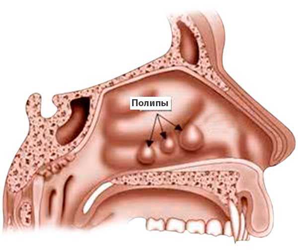 Полит носа. Хронический полипозный риносинусит. Полипозный аллергический ринит. Полипозный риносинусит эндоскопия.