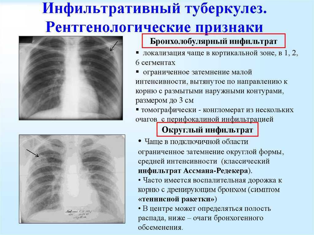 Диссеминированный туберкулез. фтизиатрия. справочник