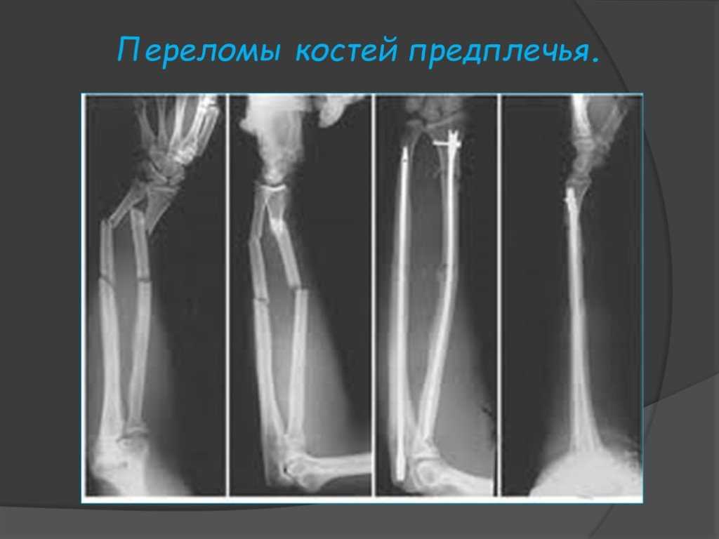 Открытый перелом кости руки. Перелом диафиза костей предплечья. Переломы диафиза костей предплечья рентген. Диафизарный перелом лучевой кости. Перелом лучевой кости рентген.
