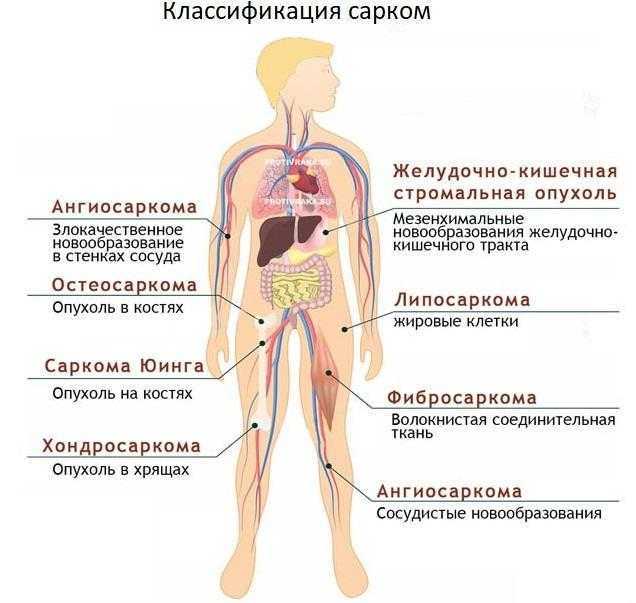 Клиническая картина при остеогенной саркоме в начале заболевания выражается следующими признаками