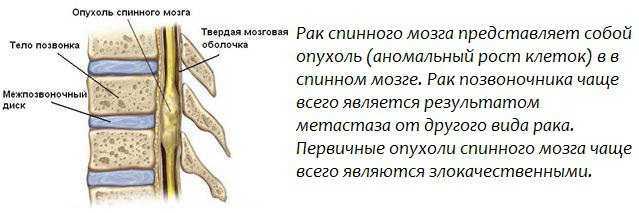 Миелит. причины, симптомы и лечение заболевания.!
