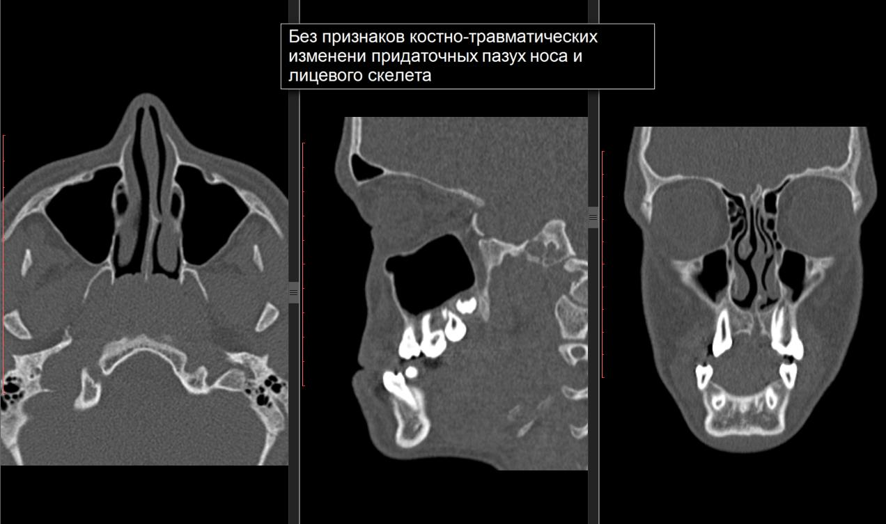 Состояние вчп. Кт придаточных пазух носа коронарная проекция. Кт околоносовых пазух норма. Нормальная кт носовой полости и пазух.