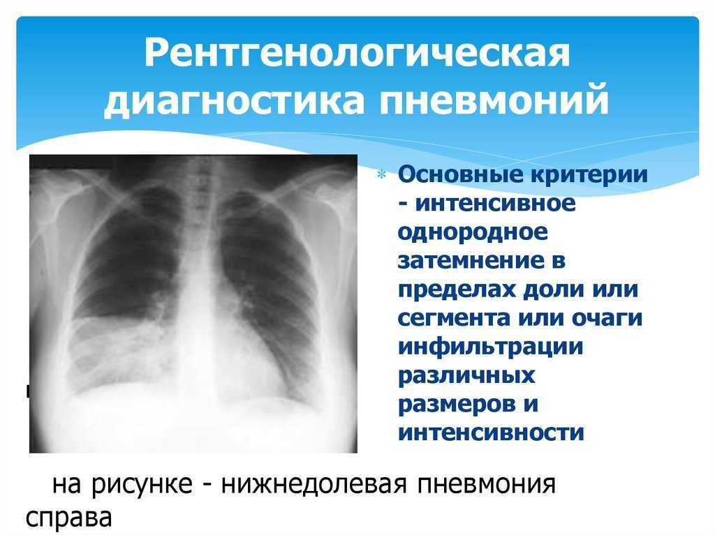 Диссеминированный процесс легких: варианты, кт-диагностика, что делать