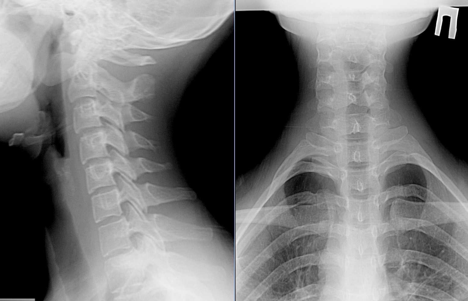 Рентген шейного отдела фото