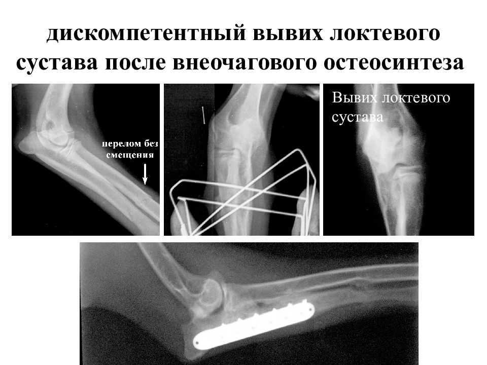 Вывих локтевого сустава карта вызова скорой медицинской