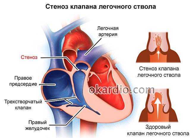 Клапан легочной артерии. Недостаточности клапанов рисунок легочной артерии. Недостаточность клапана легочной артерии схема. Недостаточность пульмонального клапана аускультация. Клапан легочного ствола.